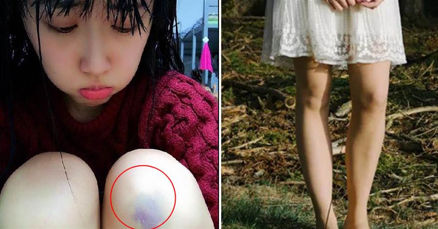為什麼女生的膝蓋上經常有淤青？千萬不要想歪了，這是很正常的現象
